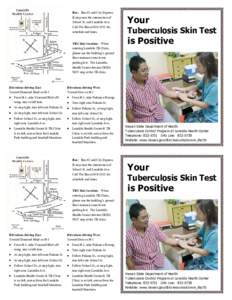 Tuberculosis treatment / Mantoux test / Tuberculosis / Medicine / Health