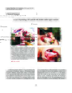 Indian J Med Res 142, September 2015, ppDOI:Clinical Images A case of pentalogy of Cantrell with double outlet right ventricle