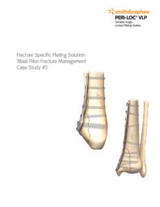 Fracture Specific Plating Solution: Tibial Pilon Fracture Management Case Study #3 Patient information 43-year-old male, injured in a fall