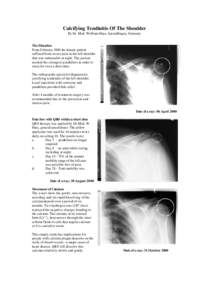 Calcifying Tendinitis Of The Shoulder By Dr. Med. Wolfram Haas, Sprendlingen, Germany The Situation From February 2000 the female patient suffered from severe pain in the left shoulder