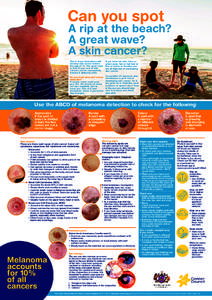 Carcinoma / Skin cancer / Melanoma / Actinic keratosis / Squamous-cell carcinoma / Sunburn / Melanocytic nevus / Basal-cell carcinoma / Cancer / Medicine / Oncology / Sun tanning