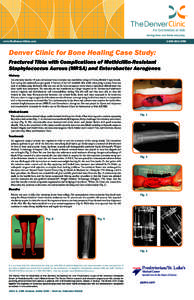 www.TheDenverClinic.com[removed]LIMB Denver Clinic for Bone Healing Case Study: Fractured Tibia with Complications of Methicillin-Resistant