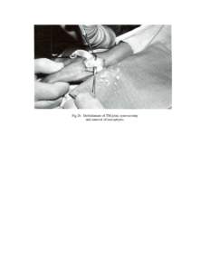 Fig 2b. Debridement of TM joint, synovectomy and removal of osteophytes. 