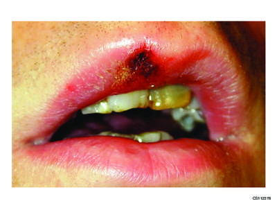 CS112378  Oral chancre, upper lip Source: Public Health Agency of Canada