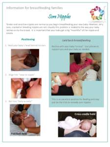 Information for breastfeeding families  Sore Nipples Tender and sensitive nipples are normal as you begin breastfeeding your new baby. However, very sore, cracked or bleeding nipples are not. Usually this problem is rela