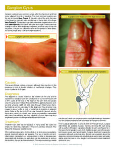 Ganglion Cysts Ganglion cysts are very common lumps within the hand and wrist that occur adjacent to joints or tendons. The most common locations are the top of the wrist (see Figure 1), the palm side of the wrist, the b