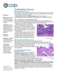 Gallbladder Cancer  What is gallbladder cancer? Definitions Bile duct: A tube that carries bile from the