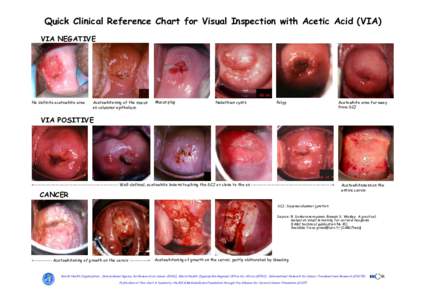 Quick Clinical Reference Chart for Visual Inspection with Acetic Acid (VIA) VIA NEGATIVE No definite acetowhite area  Acetowhitening of the mucus