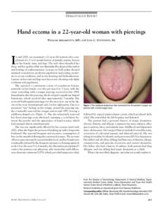 DERMATOLOGY REPORT  Hand eczema in a 22-year-old woman with piercings WILLIAM ABRAMOVITS, MD, AND LISA C. STEVENSON, BA  I