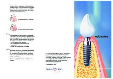 Nadat een of meer implantaten in het kaakbot zijn verankerd, plaatst de tandarts hierop de kroon, brug of prothese. Hij neemt daarvoor onder plaatselijke verdoving soms eerst een klein stukje van het tandvlees boven het 