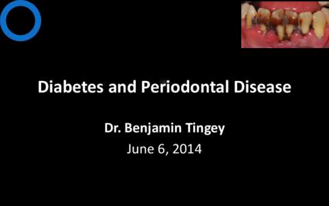 Diabetes and Periodontal Disease Dr. Benjamin Tingey June 6, 2014 Outline •