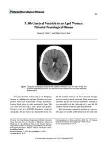 Septum pellucidum / Ventricular system / Cave of septum pellucidum / Third ventricle / Lateral ventricles / Ventricle / Anatomy / Neuroanatomy / Cerebrum