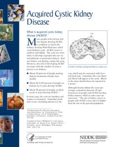 Acquired Cystic Kidney Disease