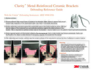 Clarity™ Metal-Reinforced Ceramic Brackets Debonding Reference Guide With the Unitek™ Debonding Instrument (REF #Remove archwire. 2) Remove adhesive flash around base of bracket to be debonded. Note: Fail