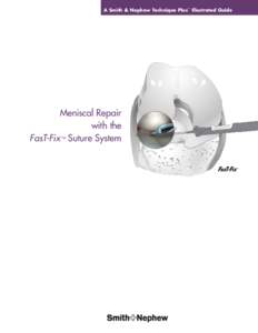 A Smith & Nephew Technique Plus™ Illustrated Guide  Meniscal Repair with the FasT-Fix ™ Suture System